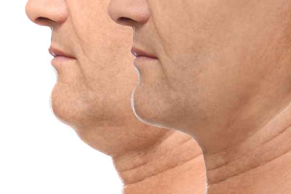HIFU - Breakthrough in Anti - ageing 2 hifu results Bicester