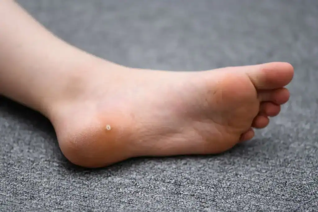 Cryotherapy For Warts And Also Verrucas 2 Image of verruca on the bottom of the foot that able to be treated with Cryotherapy Bicester