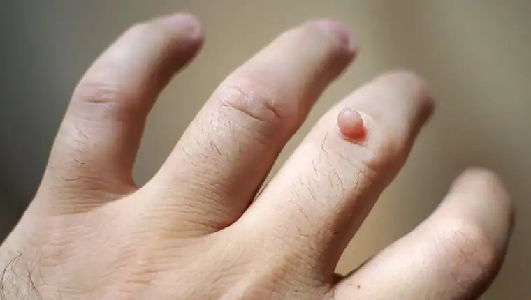 Image of blemish that Cryotherapy Bicester can remove with Lipo 360.