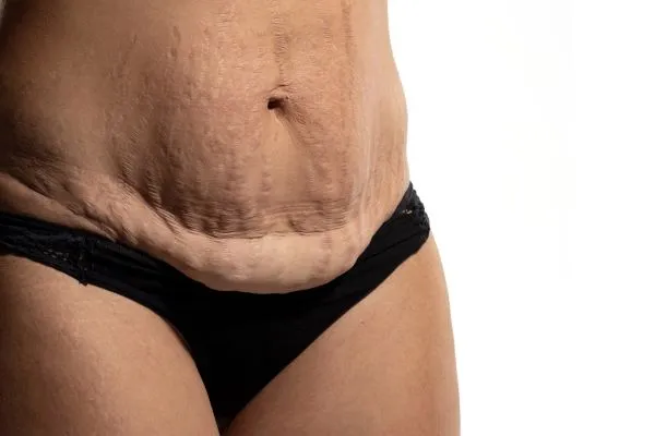 The Science of Skin Tightening 1 The science behind skin tightening Bicester picture of a woman's sagging skin on the stomach